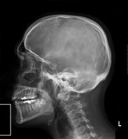 Le radiografie fanno male